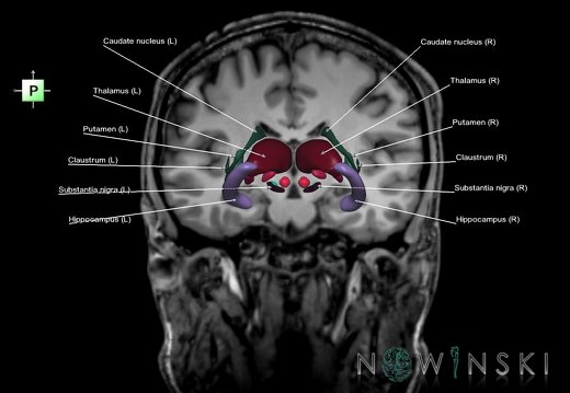 G6.T11.1.V3.P-17S.Deep nuclei all–Triplanar