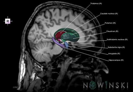 G6.T11.1.V4.P-10S.Deep nuclei all–Triplanar