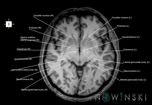 G6.T11.1.V6.P-04.Deep nuclei all–Triplanar