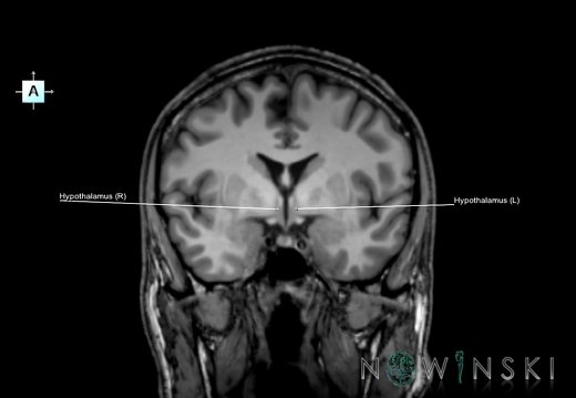 G6.T11.10.V1.P-03.Hypothalamus–Triplanar