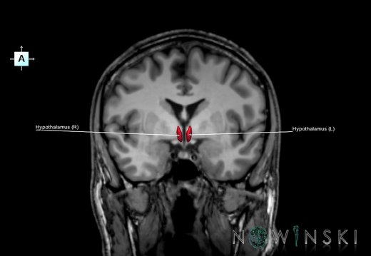 G6.T11.10.V1.P-03S.Hypothalamus–Triplanar