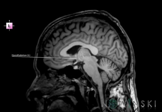 G6.T11.10.V2.P04.Hypothalamus–Triplanar