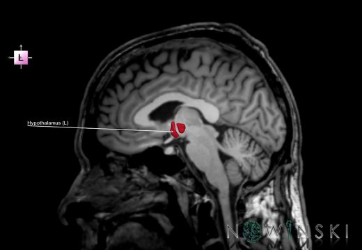 G6.T11.10.V2.P04S.Hypothalamus–Triplanar