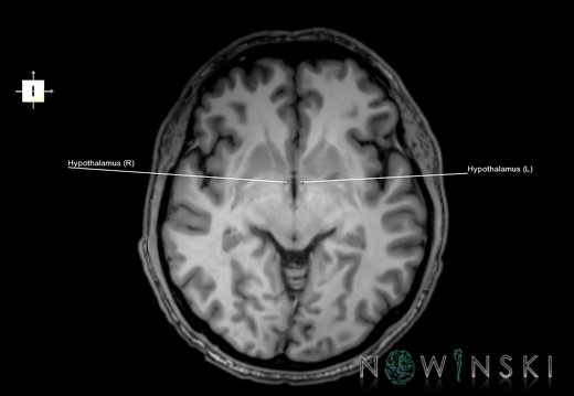 G6.T11.10.V6.P-04.Hypothalamus–Triplanar