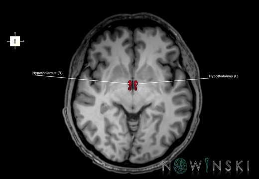 G6.T11.10.V6.P-04.SHypothalamus–Triplanar