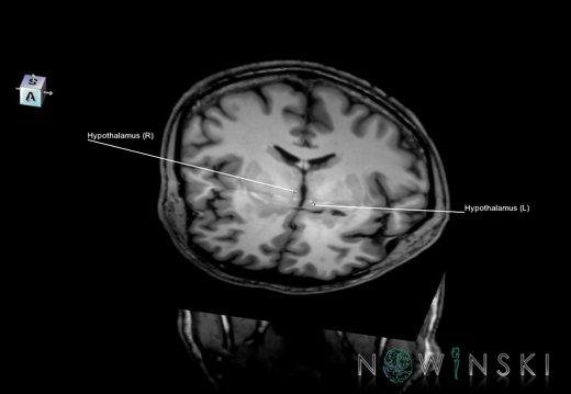 G6.T11.10.V7.P-06.-07.Hypothalamus–Triplanar