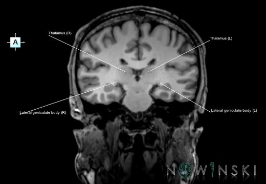 G6.T11.11.V1.P-26.Thalamus–Triplanar