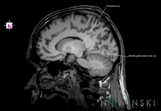 G6.T11.11.V2.P13.Thalamus–Triplanar