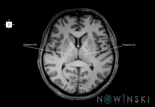 G6.T11.11.V6.P07.Thalamus–Triplanar