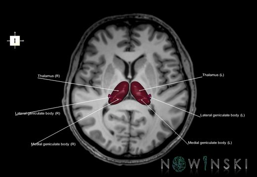 G6.T11.11.V6.P07S.Thalamus–Triplanar