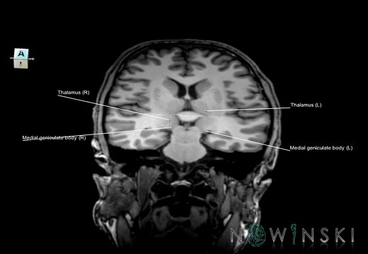 G6.T11.11.V7.P14.-27.Thalamus–Triplanar