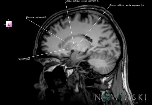 G6T11.2.BasalGanglia–Triplanar