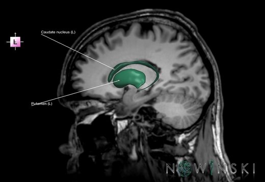 G6.T11.2.V2.P19S.Basal ganglia–Triplanar