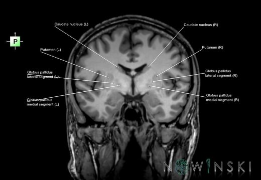 G6.T11.2.V3.P-06.Basal ganglia–Triplanar