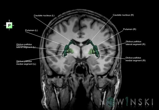 G6.T11.2.V3.P-06S.Basal ganglia–Triplanar