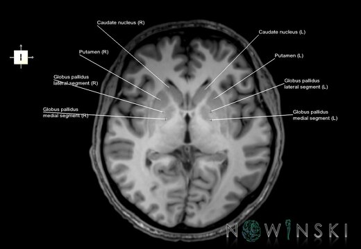 G6.T11.2.V6.P01.Basal ganglia–Triplanar