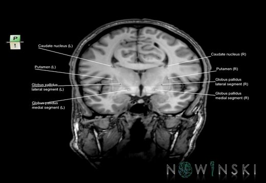 G6.T11.2.V7.P05.-04.Basal ganglia–Triplanar