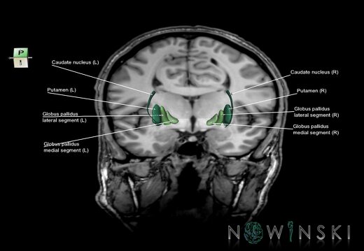 G6.T11.2.V7.P05.-04S.Basal ganglia–Triplanar