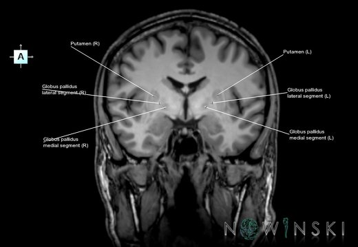 G6T11.3.LentiformNucleus–Triplanar