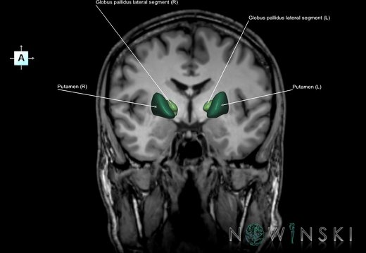 G6.T11.3.V1.P-06S.Lentiform nucleus–Triplanar