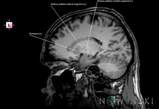 G6.T11.3.V2.P19.Lentiform nucleus–Triplanar