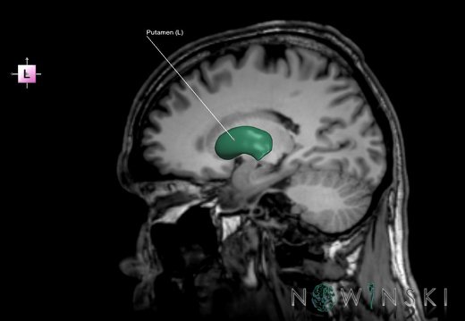 G6.T11.3.V2.P19S.Lentiform nucleus–Triplanar