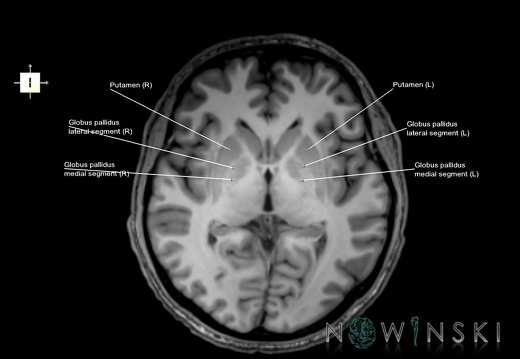 G6.T11.3.V6.P01.Lentiform nucleus–Triplanar