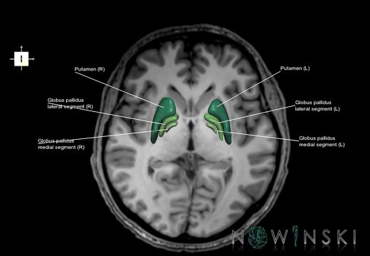 G6.T11.3.V6.P01S.Lentiform nucleus–Triplanar