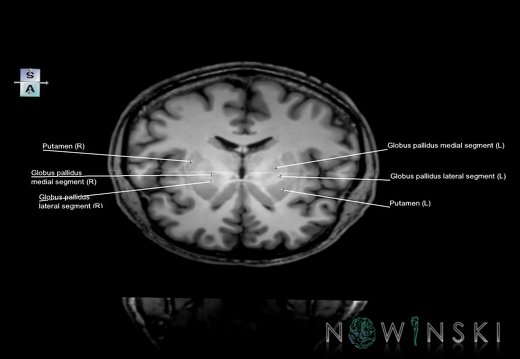 G6.T11.3.V7.P-01.-08.Lentiform nucleus–Triplanar