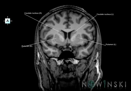 G6.T11.4.V1.P05.Corpus striatum–Triplanar