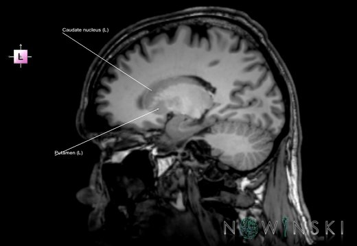 G6.T11.4.V2.P18.Corpus striatum–Triplanar