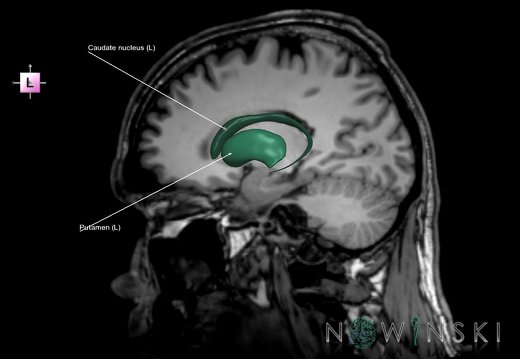 G6.T11.4.V2.P18S.Corpus striatum–Triplanar