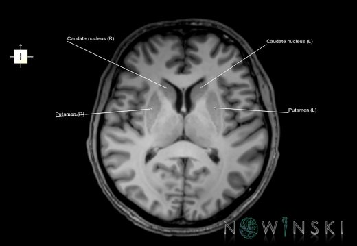 G6.T11.4.V6.P09.Corpus striatum–Triplanar