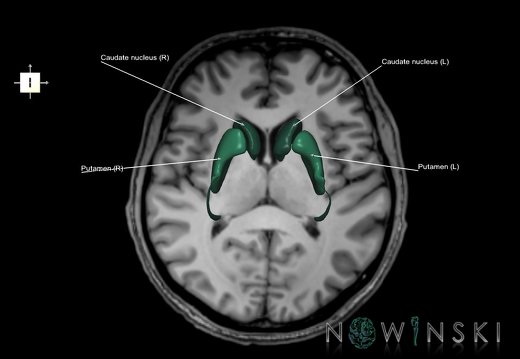 G6.T11.4.V6.P09S.Corpus striatum–Triplanar