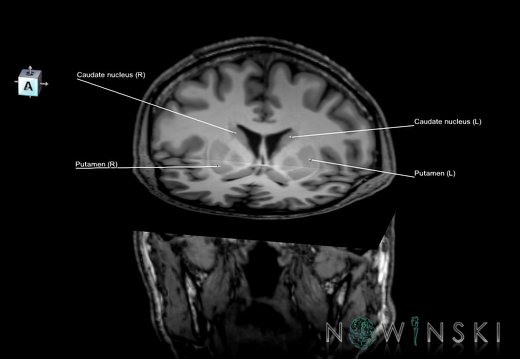 G6.T11.4.V7.P02.-01.Corpus striatum–Triplanar