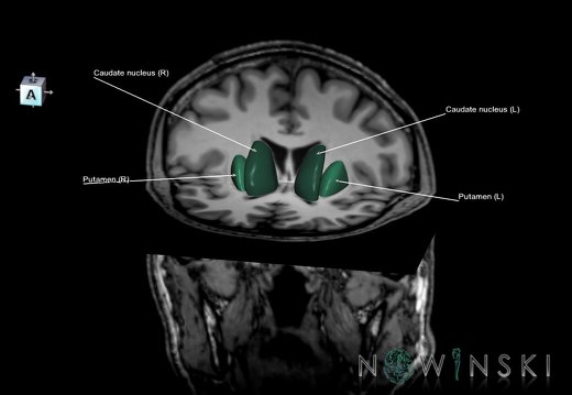 G6.T11.4.V7.P02.-01S.Corpus striatum–Triplanar