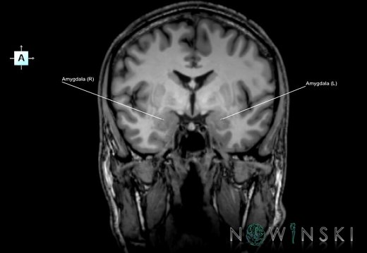 G6.T11.7.V1.P-05.Amygdala–Triplanar