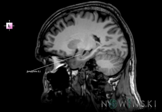 G6.T11.7.V2.P23.Amygdala–Triplanar