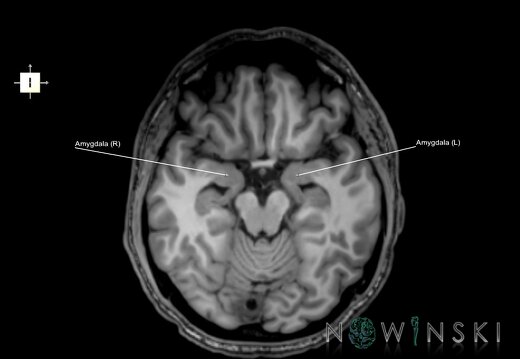 G6.T11.7.V6.P-14.Amygdala–Triplanar