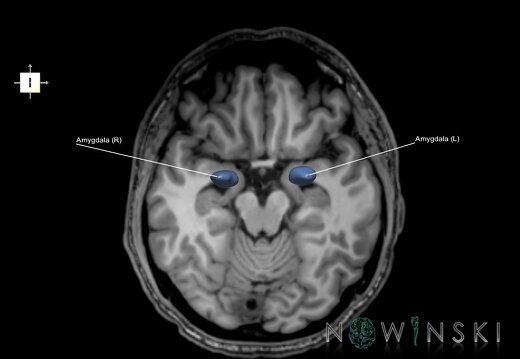 G6.T11.7.V6.P-14S.Amygdala–Triplanar