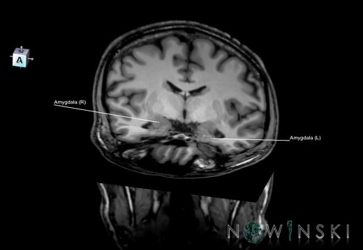 G6.T11.7.V7.P-19.-09.Amygdala–Triplanar