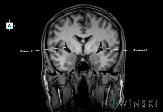 G6T11.8.Claustrum–Triplanar
