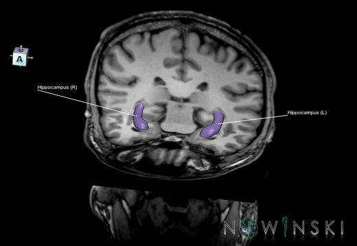 G6T11.9.Hippocampus–Triplanar