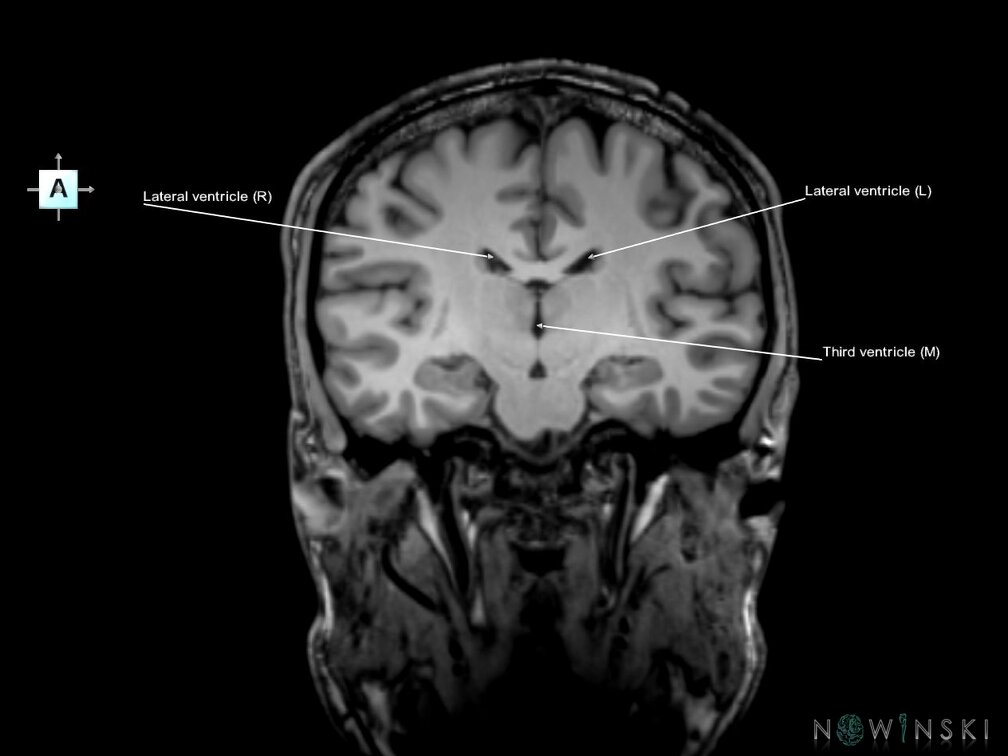 G6.T12.V1.P-19.Cerebral ventricles–Triplanar