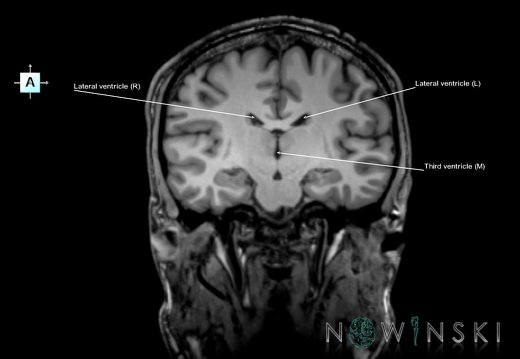 G6.T12.V1.P-19.Cerebral ventricles–Triplanar