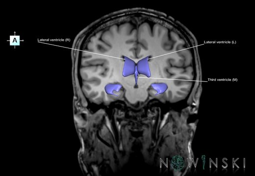 G6.T12.V1.P-19S.Cerebral ventricles–Triplanar