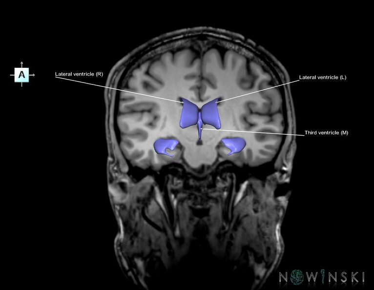 G6.T12.V1.P-19S.Cerebral_ventricles–Triplanar.tiff