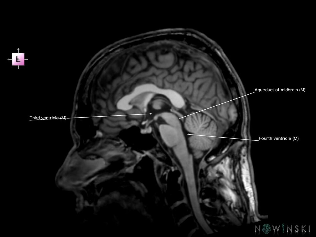 G6.T12.V2.P00.Cerebral ventricles–Triplanar
