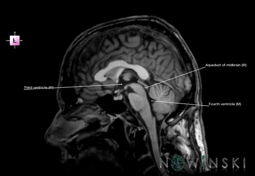 G6.T12.V2.P00.Cerebral ventricles–Triplanar