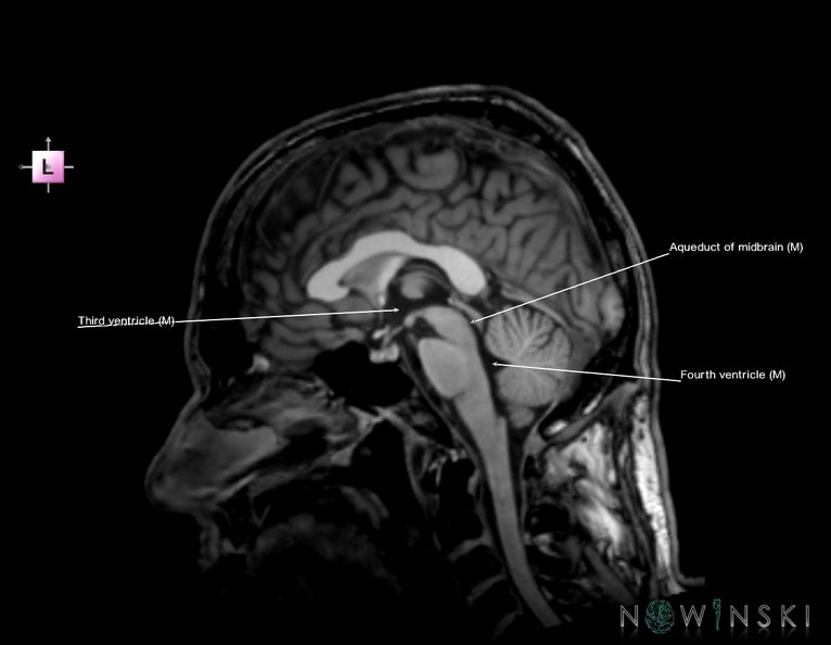 G6.T12.V2.P00.Cerebral_ventricles–Triplanar.tiff